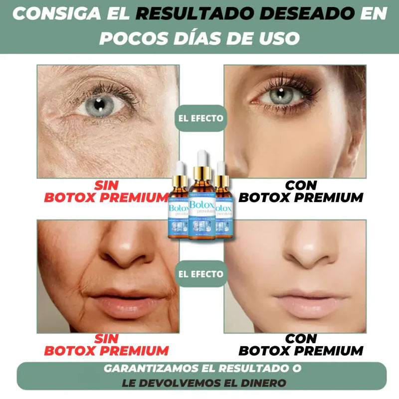 Renew® Botox facial suavizante